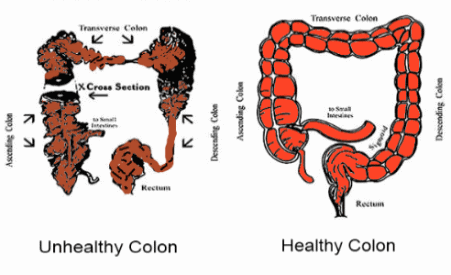 Why Need Colon Hydrotherapy