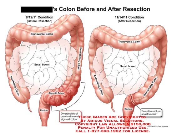Why Need Colon Hydrotherapy